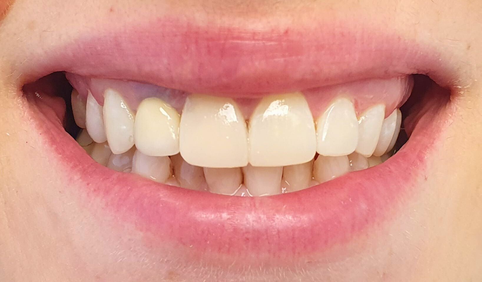 Composite Bonding Dental Art Implant Clinics